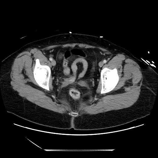 File:Closed loop small bowel obstruction due to adhesive bands - early and late images (Radiopaedia 83830-99014 A 140).jpg