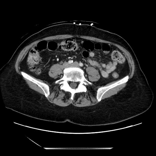 Closed loop small bowel obstruction due to adhesive bands - early and late images (Radiopaedia 83830-99014 A 95).jpg