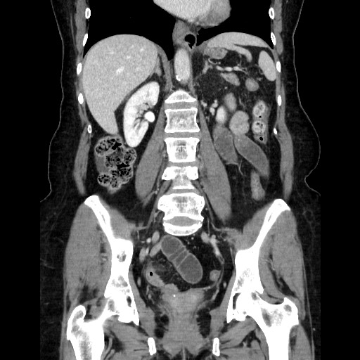 File:Closed loop small bowel obstruction due to adhesive bands - early and late images (Radiopaedia 83830-99015 B 76).jpg