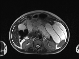 File:Closed loop small bowel obstruction in pregnancy (MRI) (Radiopaedia 87637-104031 Axial T2 23).jpg
