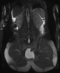 File:Closed loop small bowel obstruction in pregnancy (MRI) (Radiopaedia 87637-104031 Coronal T2 fat sat 43).jpg