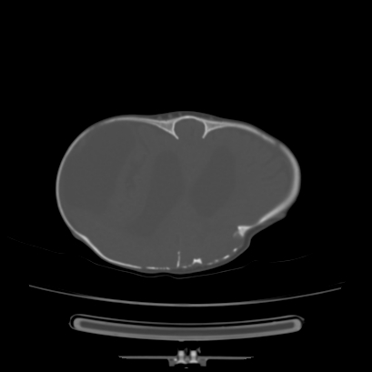 Cloverleaf skull (Radiopaedia 91901-109710 Axial bone window 111).jpg