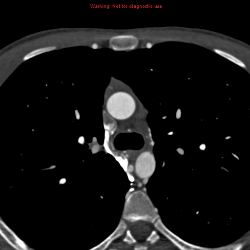 File:Coarctation of the aorta (Radiopaedia 12461-12697 A 129).jpg