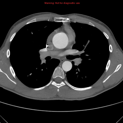 File:Coarctation of the aorta (Radiopaedia 9434-10118 A 87).jpg