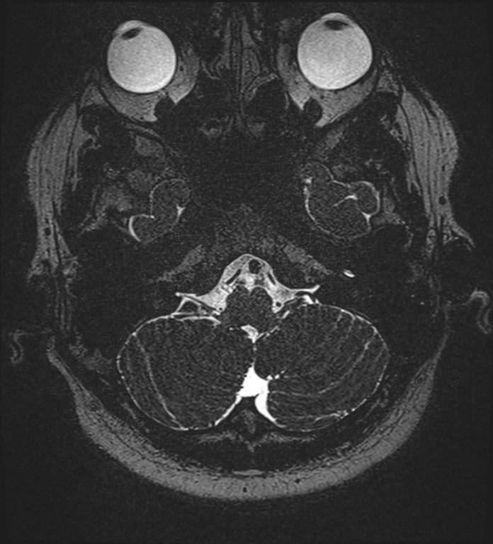 Cochlear incomplete partition type III associated with hypothalamic hamartoma (Radiopaedia 88756-105498 Axial T2 49).jpg