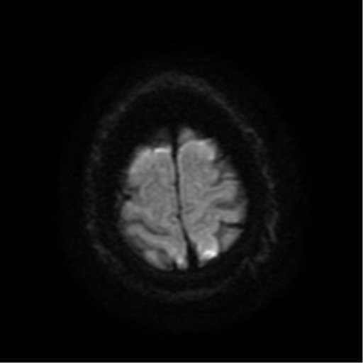 File:Colloid cyst (large) (Radiopaedia 34415-35729 Axial DWI 20).png
