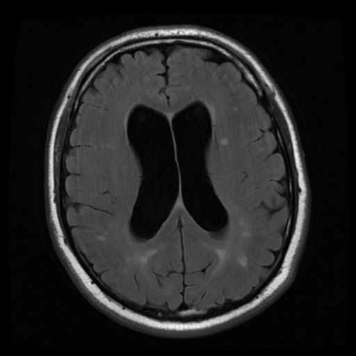 File:Colloid cyst (large) (Radiopaedia 34415-35729 Axial FLAIR 14).png