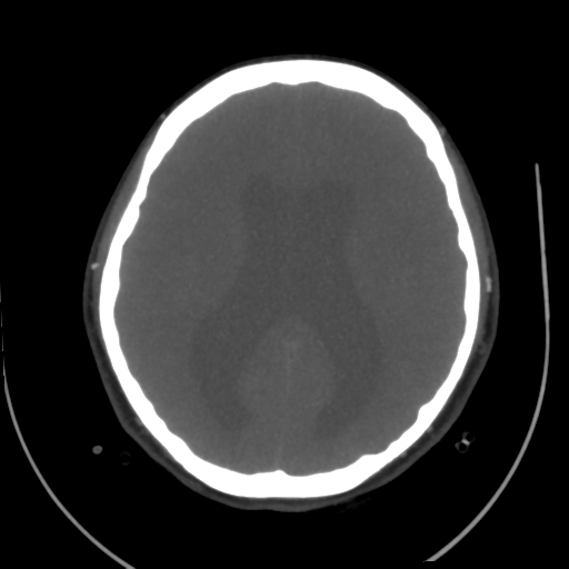 File:Colloid cyst (resulting in death) (Radiopaedia 33423-34499 A 35).png