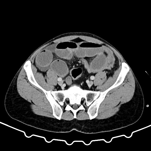 File:Colocolic intussusception due to large lipoma (Radiopaedia 68773-78482 A 145).jpg