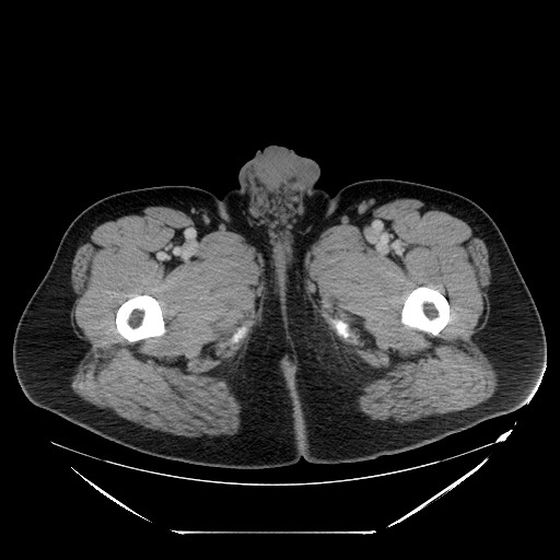 File:Colocolic intussusception due to lipoma (Radiopaedia 73712-84508 Axial 131).jpg
