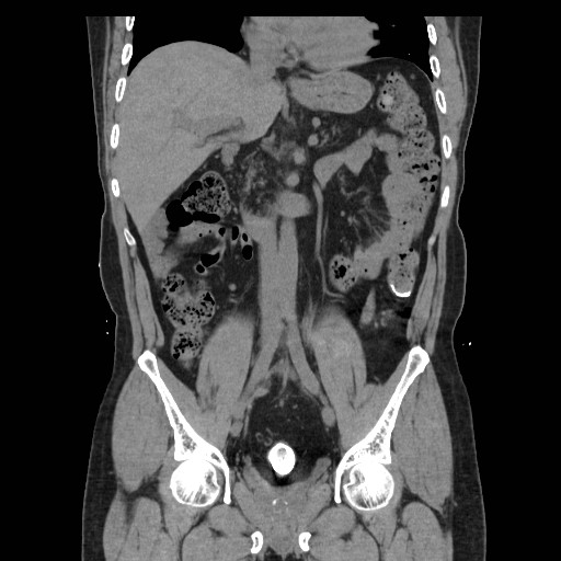File:Colocutaneous fistula in Crohn's disease (Radiopaedia 29586-30093 E 19).jpg