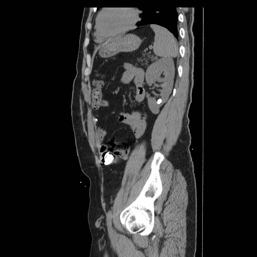 Colocutaneous fistula in Crohn's disease (Radiopaedia 29586-30093 F 37).jpg
