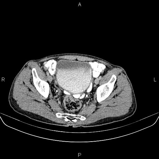 File:Colon adenocarcinoma - hepatic flexure (Radiopaedia 85635-101395 Axial C+ delayed 83).jpg
