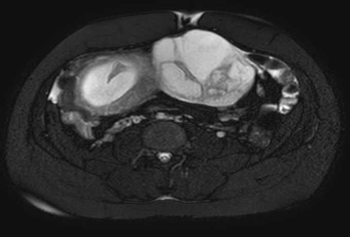 File:Colon adenocarcinoma with Krukenberg tumors, advanced pregnancy (Radiopaedia 67279-76645 Axial T2 SPAIR 36).jpg