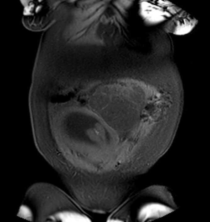 Colon adenocarcinoma with Krukenberg tumors, advanced pregnancy (Radiopaedia 67279-76645 E 9).jpg