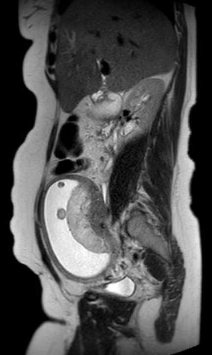 Colon adenocarcinoma with Krukenberg tumors, advanced pregnancy (Radiopaedia 67279-76645 Sagittal T2 33).jpg