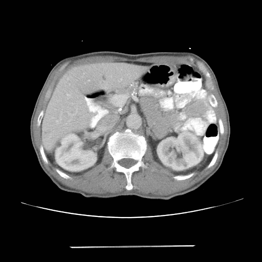 Colon cancer with calcified liver metastasis (Radiopaedia 74423-85307 A 25).jpg