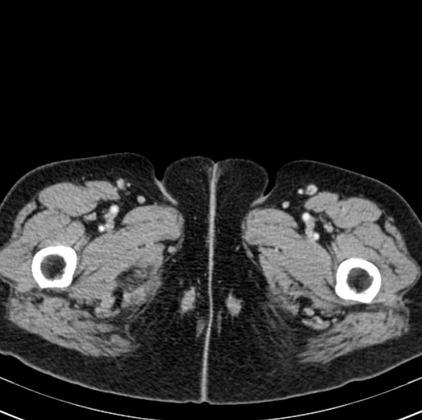 Colon carcinoma with hepatic metastases (Radiopaedia 29477-29961 A 132).jpg