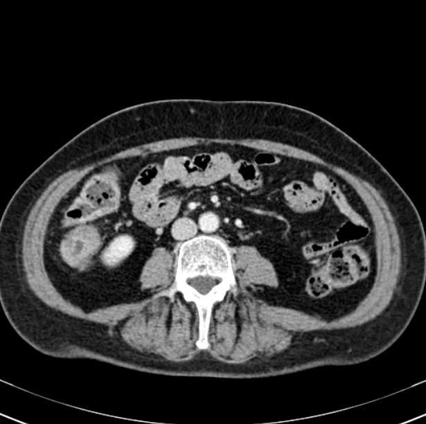 Colon carcinoma with hepatic metastases (Radiopaedia 29477-29961 A 63).jpg