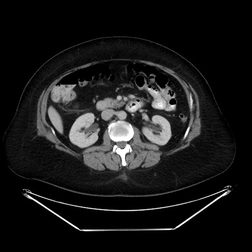 File:Colonic intussusception due to adenocarcinoma (Radiopaedia 86828-102987 Axial 43).jpg