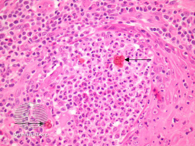 File:High-power view of histology (DermNet NZ pathology-e-chromoblastomycosis-figure-4).jpg