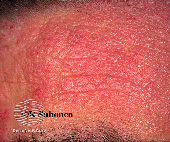 File:Lichenified forehead (DermNet NZ dermatitis-s-atopic5).jpg