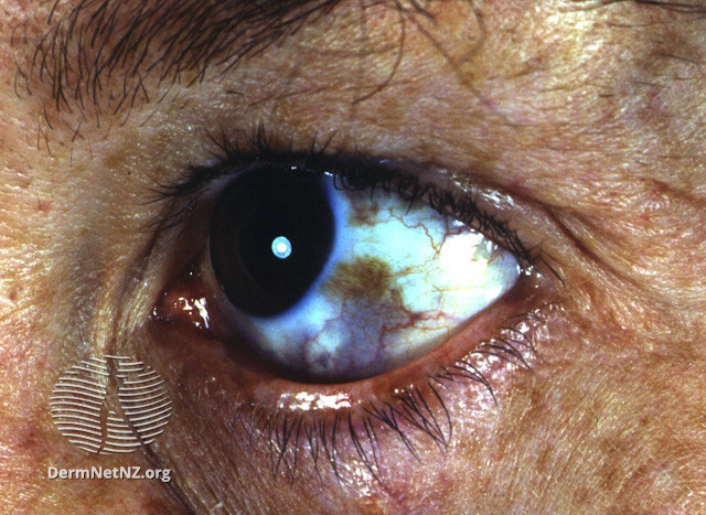 File:Naevus of Ota (DermNet NZ lesions-ota2).jpg