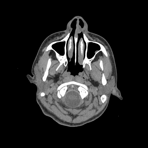 Nasal pyogenic granuloma (lobular capillary hemangioma) (Radiopaedia 85536-101244 Axial non-contrast 19).jpg