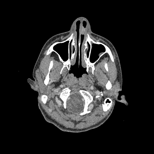 Nasal pyogenic granuloma (lobular capillary hemangioma) (Radiopaedia 85536-101244 C 36).jpg