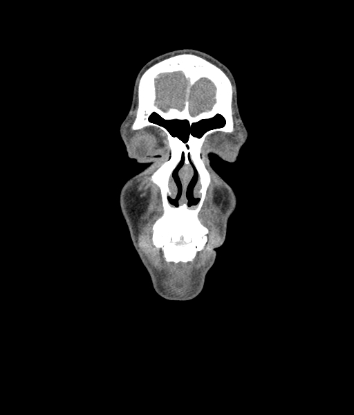 Nasal pyogenic granuloma (lobular capillary hemangioma) (Radiopaedia 85536-101244 D 48).jpg