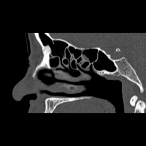 Nasal septal perforation (Radiopaedia 25030-25289 Sagittal bone window 38).jpg