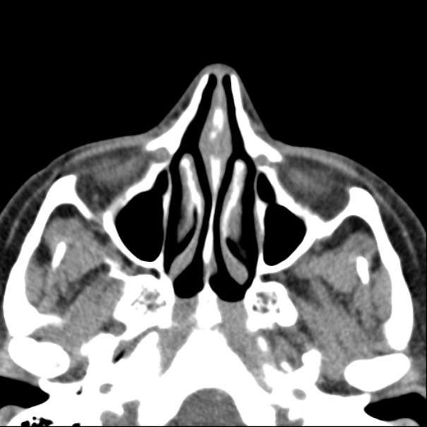 Nasolabial cyst (Radiopaedia 33987-35205 Axial non-contrast 24).jpg