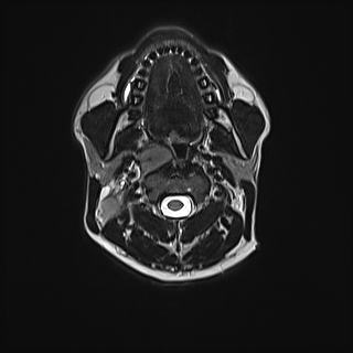 Nasopharyngeal carcinoma with perineural spread (Radiopaedia 55030-61380 Axial T2 40).jpg