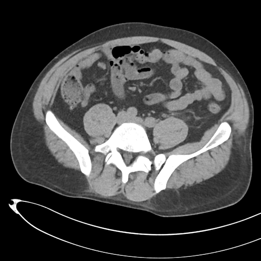File:Necrotizing pancreatitis with acute necrotic collections (Radiopaedia 38829-41012 Axial non-contrast 56).png