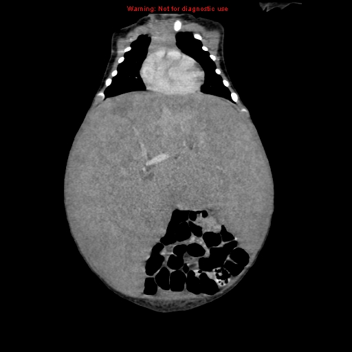 File:Neonatal neuroblastoma (Radiopaedia 9564-10223 B 47).jpg