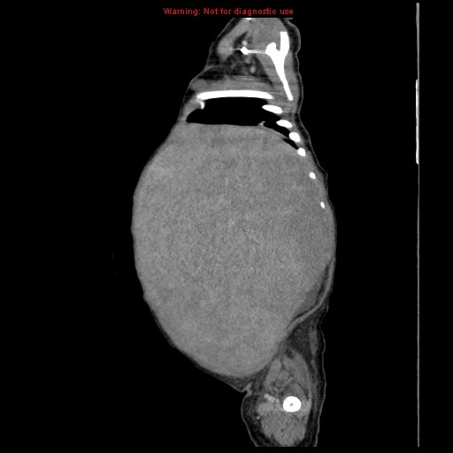 File:Neonatal neuroblastoma (Radiopaedia 9564-10223 C 31).jpg