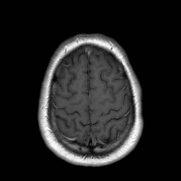 File:Neuro-Behcet's disease (Radiopaedia 21557-21505 Axial T1 C+ 19).jpg