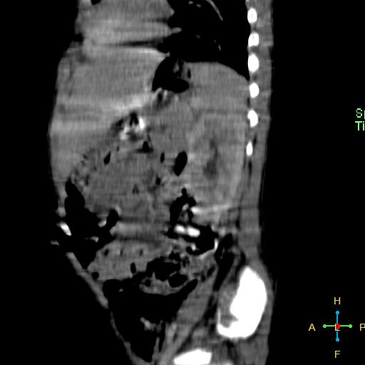 File:Neuroblastoma (Radiopaedia 24751-25016 C 8).jpg