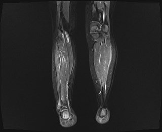 File:Neuroblastoma with bone metastases (Radiopaedia 67080-76414 B 13).jpg
