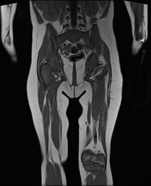 File:Neuroblastoma with bone metastases (Radiopaedia 67080-76414 Coronal T1 16).jpg