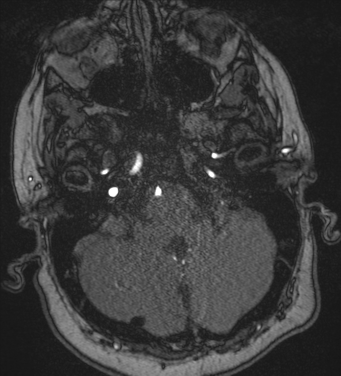 Neurofibromatosis type 1 - head and neck - CNS manifestations (Radiopaedia 49910-55188 Axial MRA 9).png