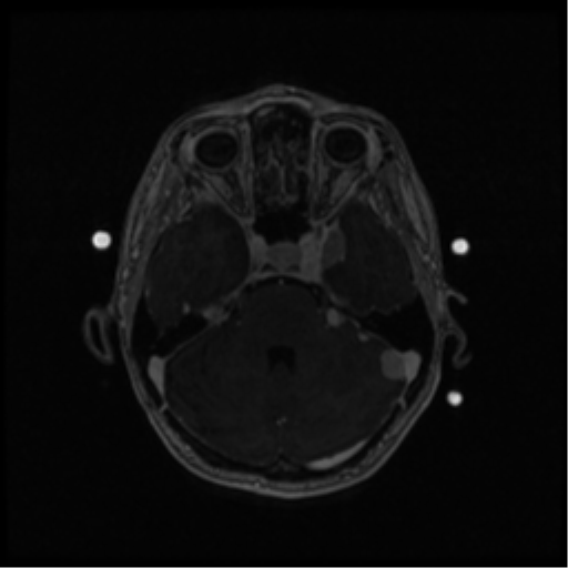 Neurofibromatosis type 2 (Radiopaedia 45229-49244 Axial T1 C+ 44).png