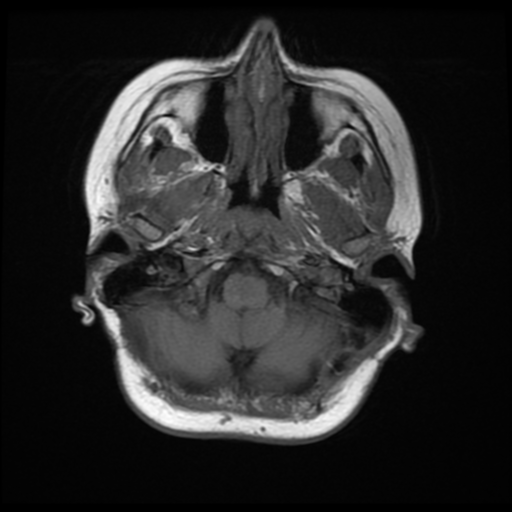 File:Neurofibromatosis type 2 (Radiopaedia 45229-49247 Axial T1 4).png