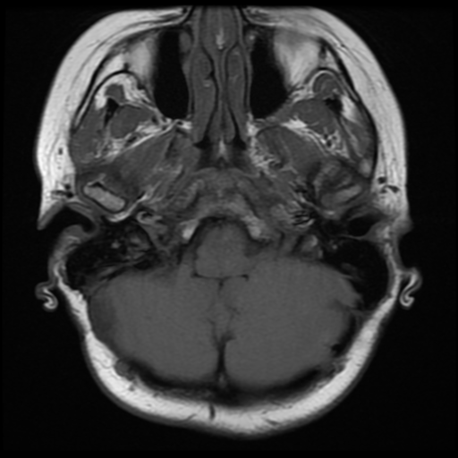 File:Neurofibromatosis type 2 (Radiopaedia 45229-49251 Axial T1 8).png