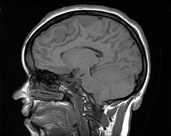File:Neurofibromatosis type 2 (Radiopaedia 66211-75401 Sagittal T1 15).jpg