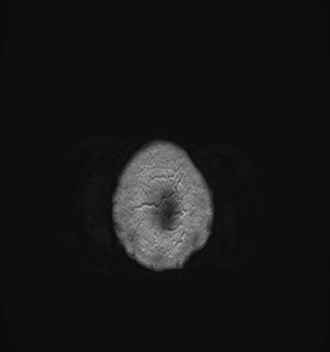 Neurofibromatosis type 2 (Radiopaedia 79097-92049 Axial T1 C+ 190).jpg