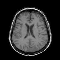 File:Neurofibromatosis type 2 (Radiopaedia 8713-9518 Axial T1 10).jpg
