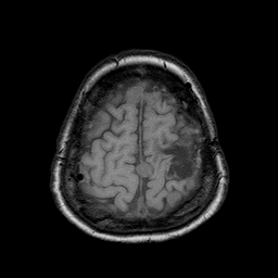 File:Neurofibromatosis type 2 (Radiopaedia 8713-9518 Axial T1 4).jpg