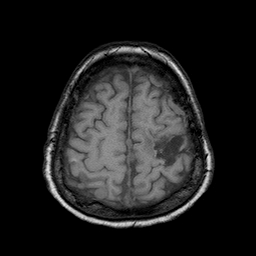 File:Neurofibromatosis type 2 (Radiopaedia 8713-9518 Axial T1 5).jpg