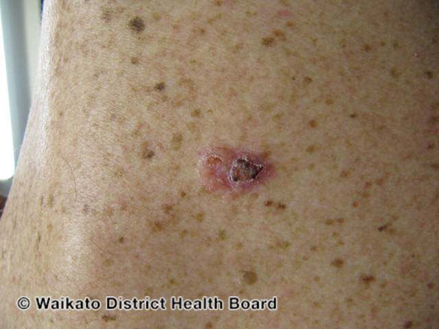 File:Nodular basal cell carcinoma, arm (DermNet NZ nbcc-arm-12-wdhb).jpg